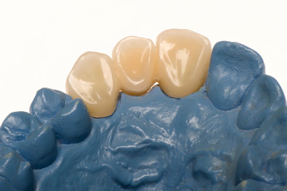 Prótesis dental fija